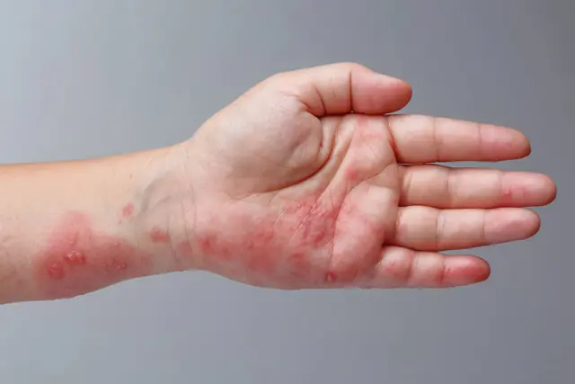 Bras et main présentant de nombreuses piqûres rouges